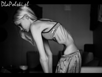 Anoreksja
